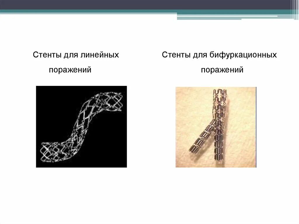 Типы стентов. Стенты для линейных поражений. Поколения стентов. Тип ячейки стента. Стент 2