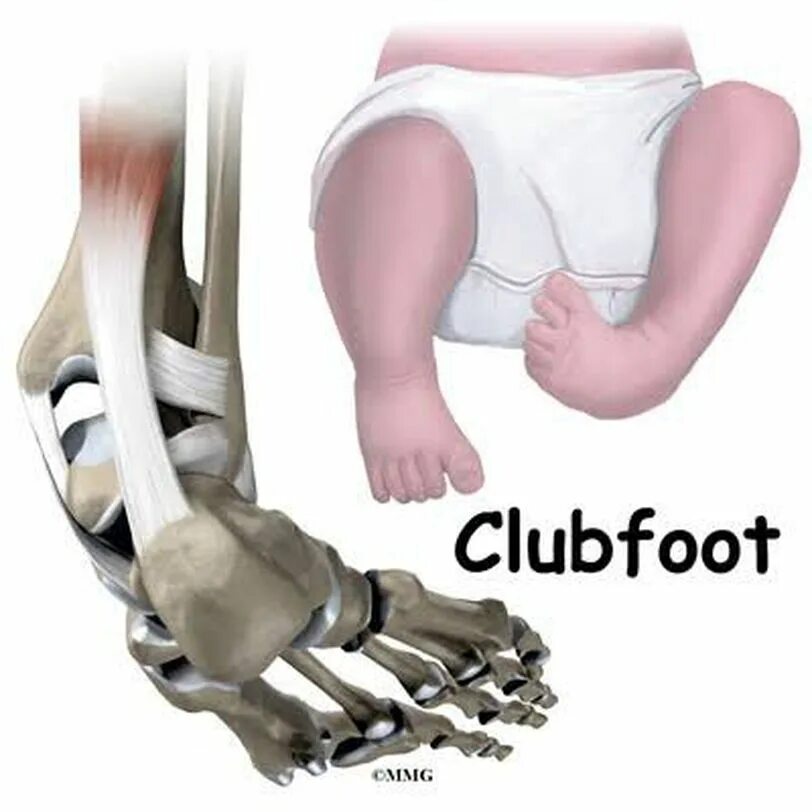 Касабиан клуб фут. Types of feet. Club foot перевод. Club foot перевод. Эмблемы фут клубов.