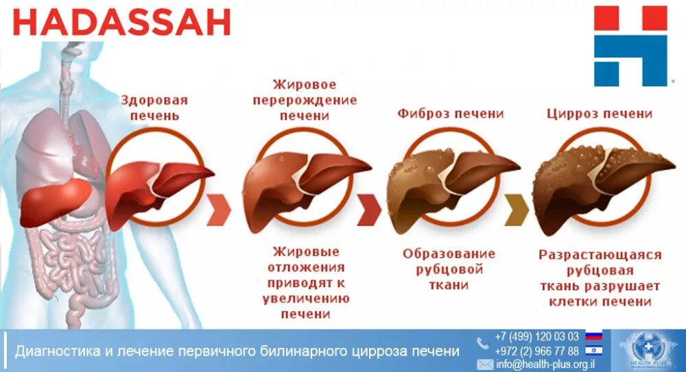 Стадии поражения печени алкоголем. Ожирение печени гепатоз печени. Стадии поражения цирроза печени. Цирроз печени ожирение печени. Симптомы фиброза у мужчин