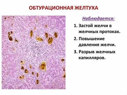 Печень при застойной желтухе микропрепарат
