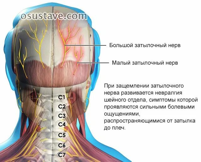 Плексопатия плечевого сустава симптомы. Ущемление нерва в шейном отделе. Ущемление нерва в шейном отделе. При остеохондрозе грудного отдела. Защемление корешкового нерва.