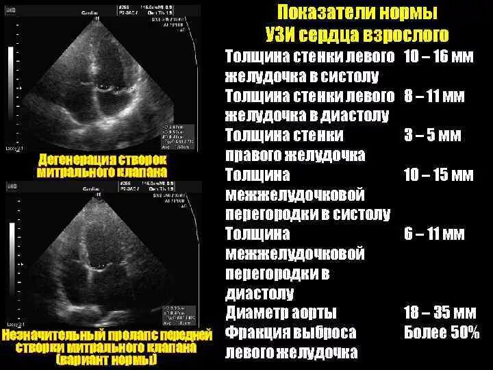 Как проходят эхо. Норма левого желудочка сердца на УЗИ. Нормы Эхо кг сердца. УЗИ сердца нормальные показатели. Эхограмма сердца в норме.