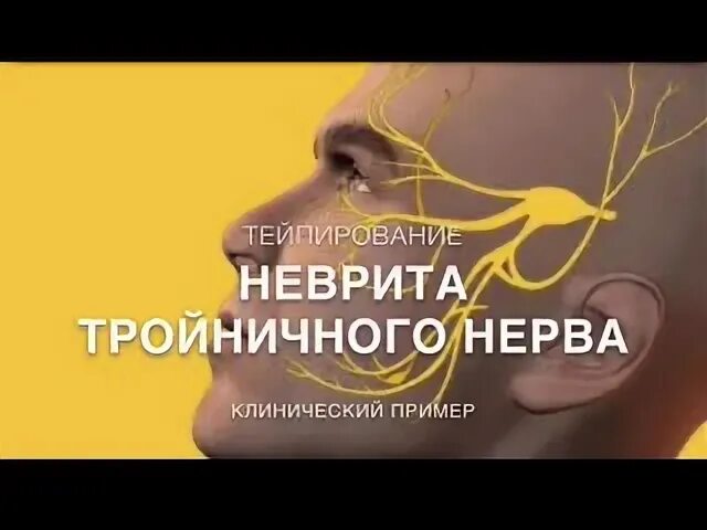 Тейпирование при неврите лицевого нерва схема видео
