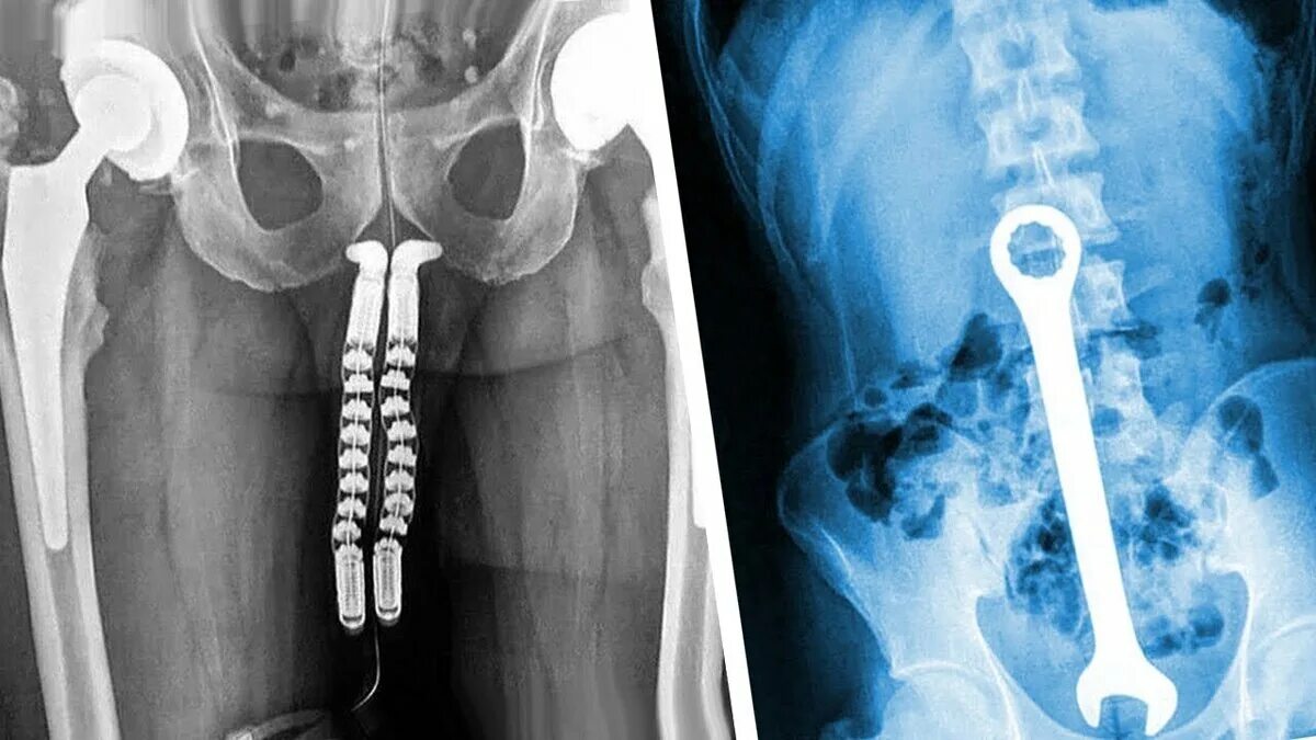 Засунул теткам. Необычные предметы на рентгене. Необычные вещи на рентгене. Необычные рентгеновские снимки. Инородные предметы на рентгене.