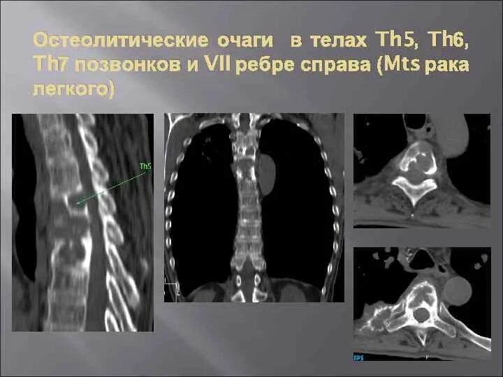 Очаговые изменения костей. Остеолитический очаг в позвонке кт. Остеолитические метастазы кт. Остеобластические метастазы позвоночника на кт. Склеротический очаг в позвонке.