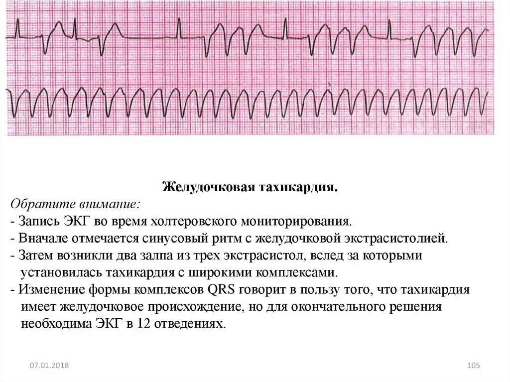 Тахикардия осложнения. Пароксизмальная желудочковая тахикардия на ЭКГ. Полиморфная желудочковая тахикардия ЭКГ. Описание ЭКГ при желудочковой тахикардии. ЭКГ критерии пароксизмальной желудочковой тахикардии.