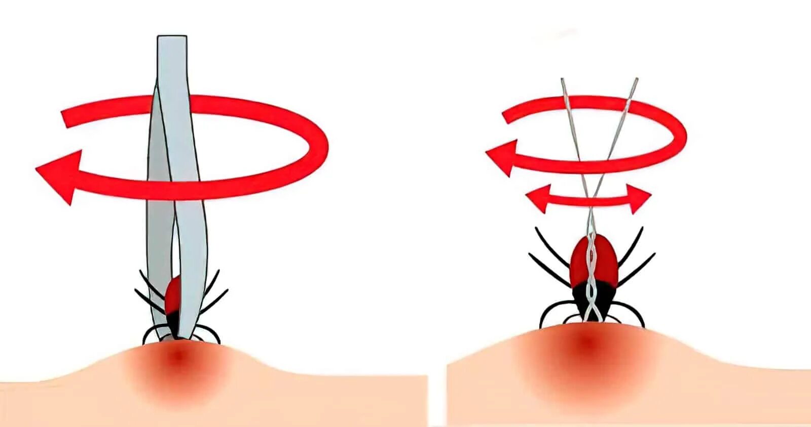 Удалить клеща в домашних условиях самостоятельно. Как удалить клеща пинцетом. Как вытащить клеща пинцетом. Как достать клеща с помощью нитки. Как вытащить клеща самостоятельно в домашних условиях.