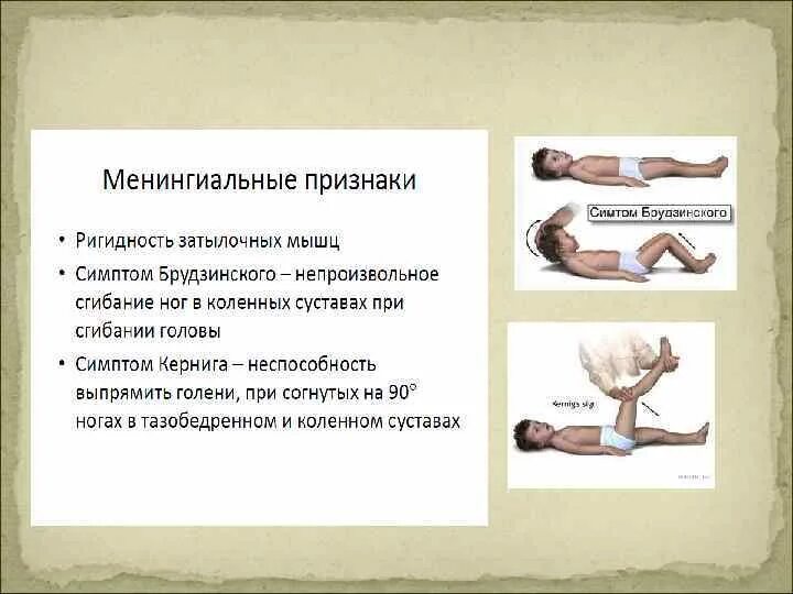 Ригидность мышц затылка симптом кернига. Менингеальные симптомы брудзинского. симптом кернига и брудзинского. ригидность затылочных мышц, симптомы брудзинского, кернига.