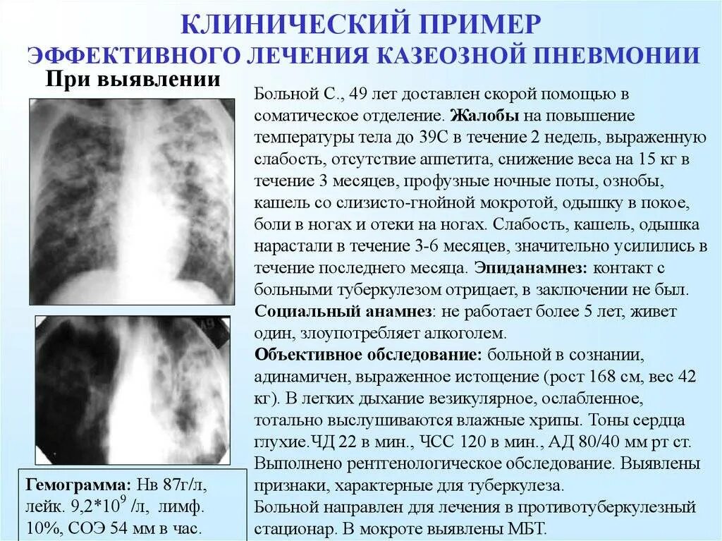 Фиброз легких врач. Легкая форма пневмонии. Клинические симптомы пневмонии. Легкие больные пневмонией.