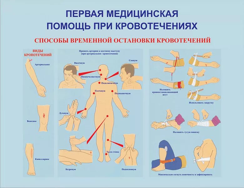 Оказание помощи при кровотечении сдо. Виды кровотечений оказание первой помощи при кровотечении. Методы остановки кровотечения схема. Методы остановки кровотечения при оказании первой помощи. Виды кровотечений приемы оказания первой помощи при кровотечениях.