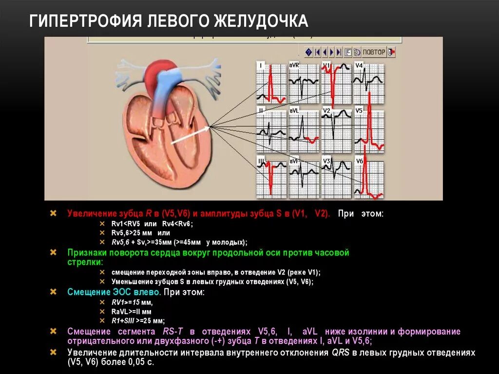 ГЛЖ на ЭХОКГ. Эхо кардиографические признаки гипертрофии левого желудочка. Гипертрофия левого желудочка на ЭКГ. Диагностические признаки гипертрофии левого желудочка.
