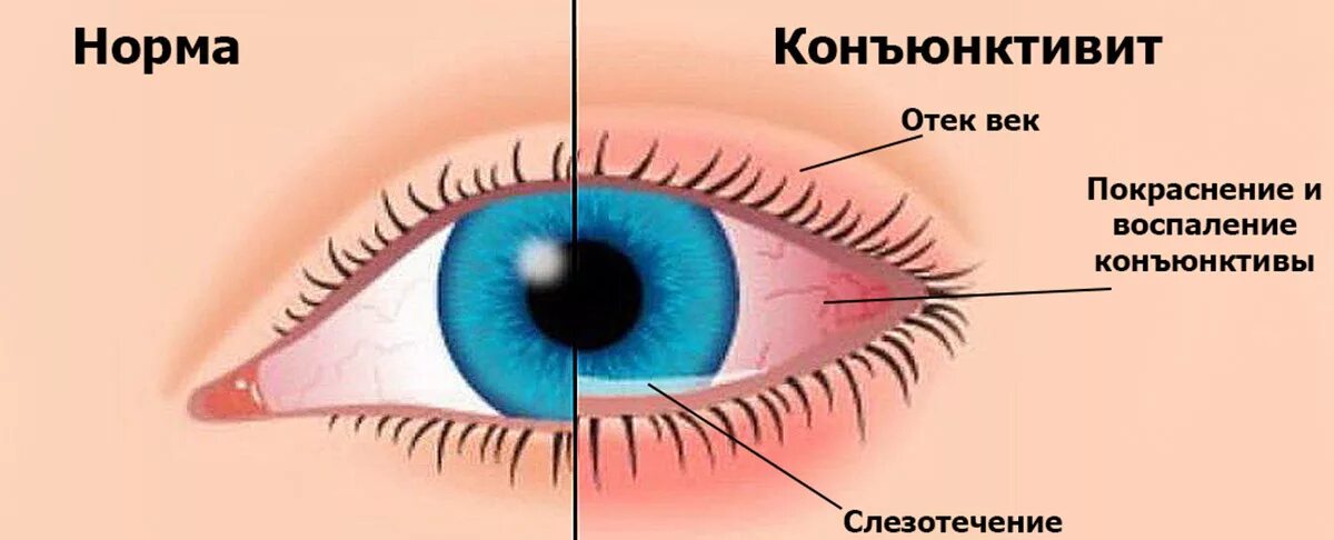 Чем отличается конъюнктивит. Острый бактериальный конъюнктивит. Аллергический конъюнктивит кон. Катаральный конъюнктивит аллергический. Конъюнктивит опухло веко.