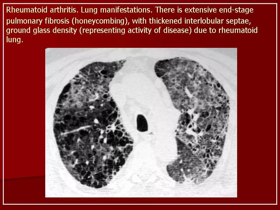 Ревматоидный артрит легких. Поражение легких при ревматоидном артрите кт. Ревматоидный артрит кт легких. Кт легких при ревматоидном артрите. Ревматоидный артрит поражение легких кт.