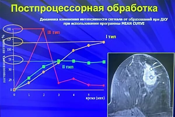типы кривых накопления контрастного вещества. типы накопления контраста. типы накопления контраста. вентрикулит. типы накопления контраста.