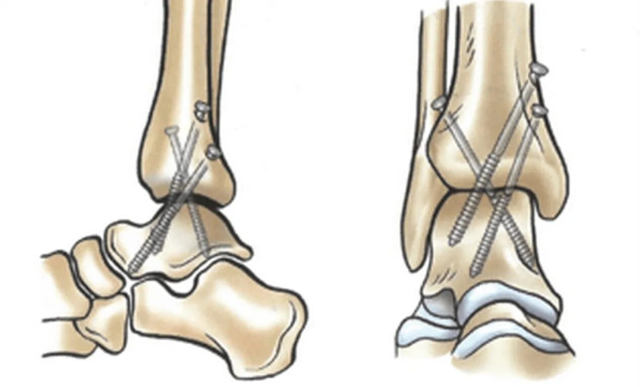 Артродез голеностопного сустава аппаратом Илизарова. Операция артродез голеностопного. Внутрисуставной артродез. Артродез суставов операция
