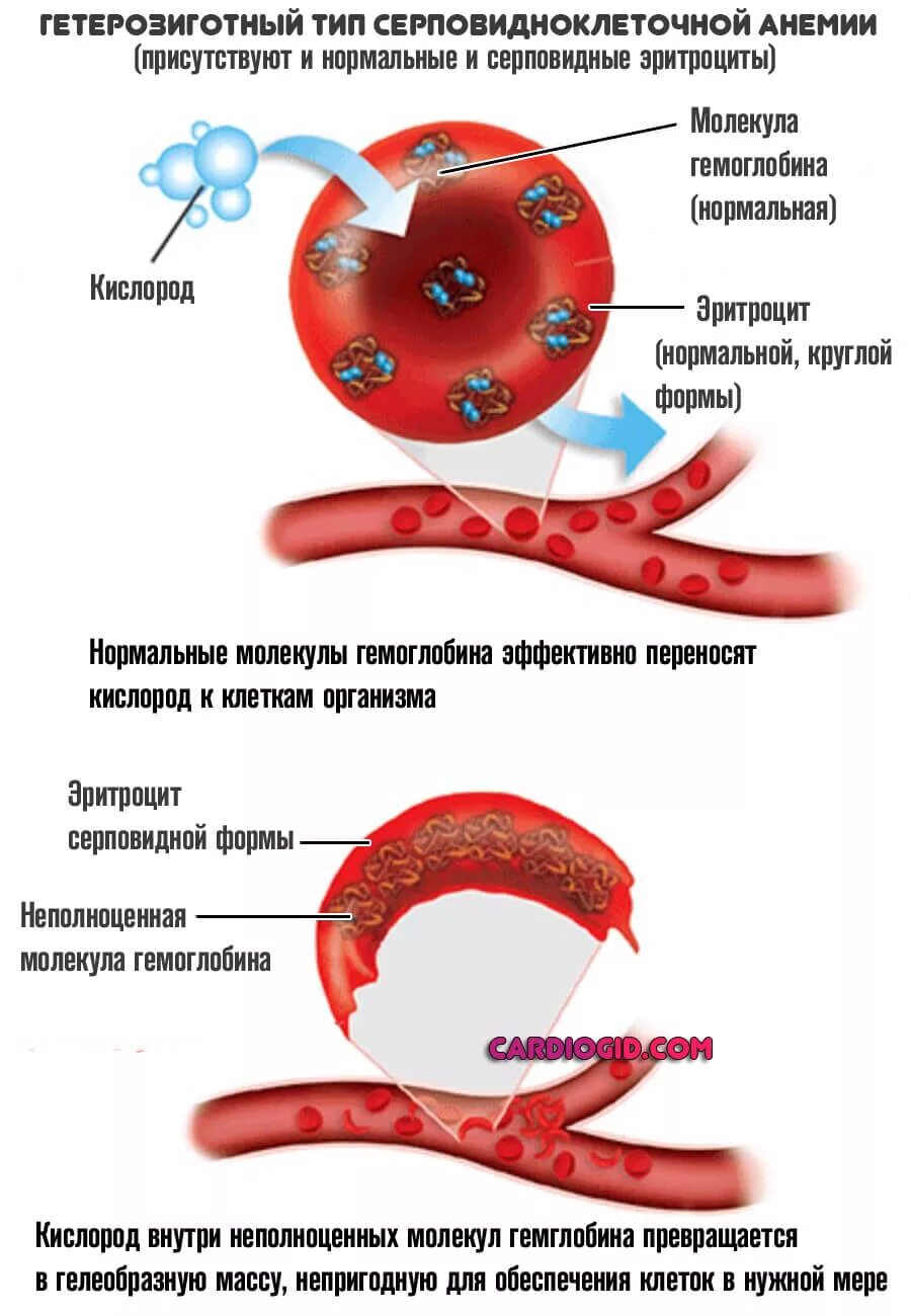 Анемия кислород. Гемоглобин s при серповидноклеточной анемии. Серповидноклеточная анемия строение гемоглобина. Форма эритроцитов при серповидноклеточной анемии. При серповидно-клеточной анемии гемоглобин:.