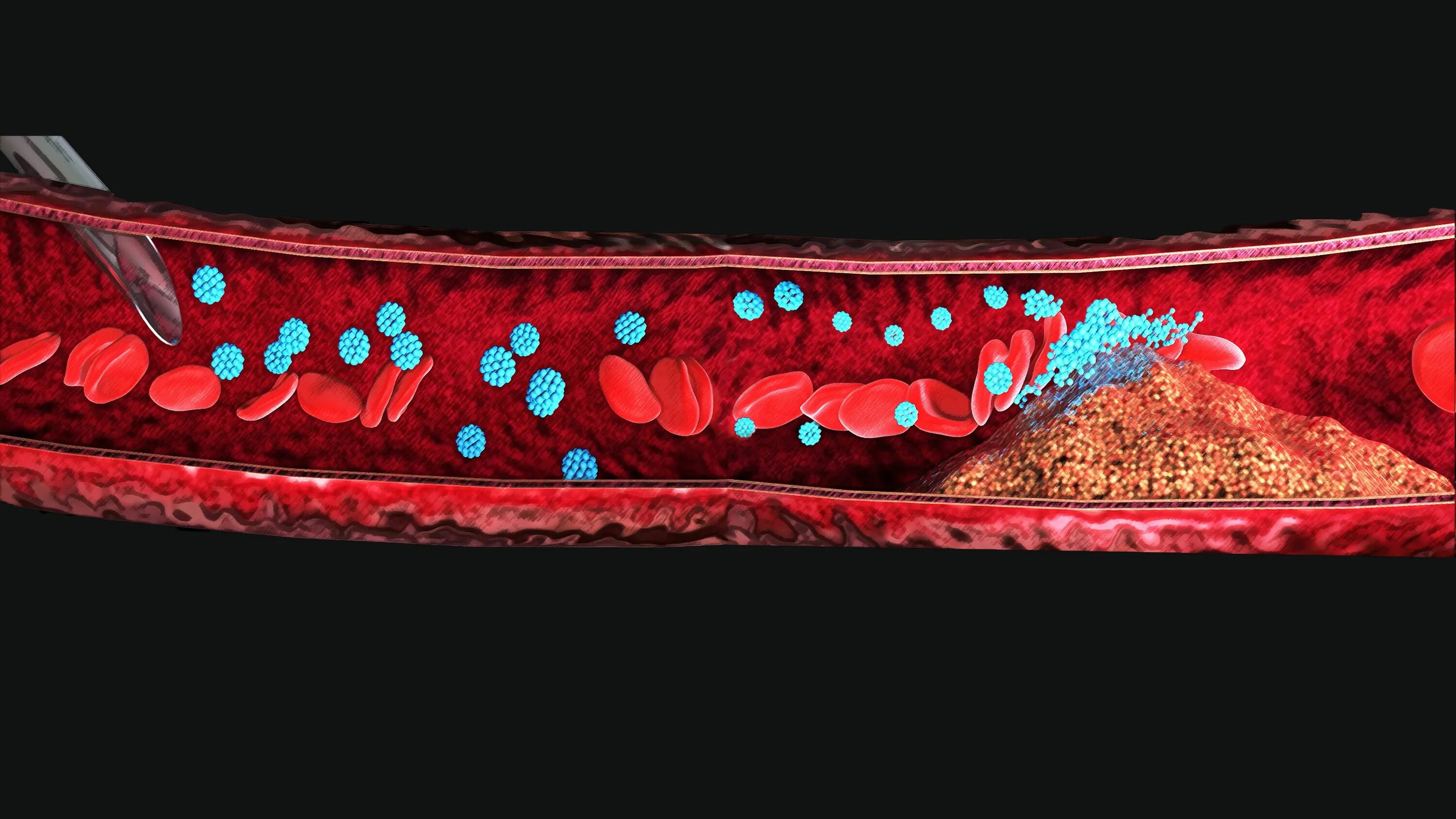 Как растворить тромб. Растворение тромбов в сосудах. Роботы в кровеносных сосудах.