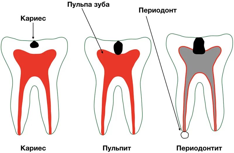 Кариес пульпит периодонтит. Пульпит периодонтит зубов. Осложнения лечения пульпита