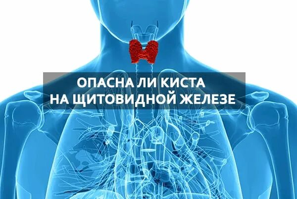 Киста щитовидной железы. Кистащетовидноижелезы. Кискисты в щитовидной железе. Киста щитовидной у мужчин