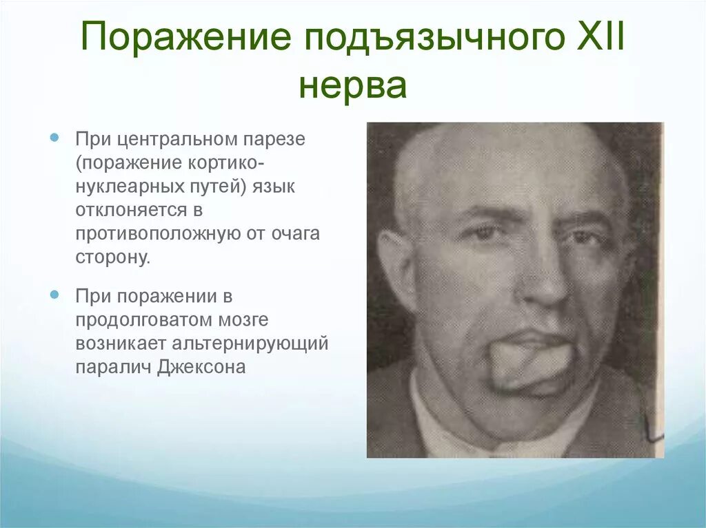 Синдром поражения подъязычного нерва. Центральный и периферический паралич подъязычного нерва. Центральный паралич подъязычного нерва. При поражении подъязычного нерва. Поражение подъязычного нерва