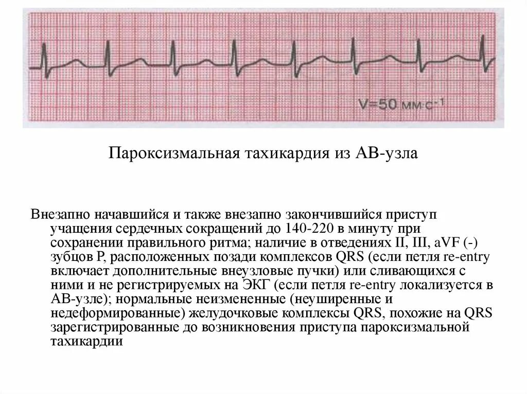 При учащении пульса длительность сердечного цикла. Электрокардиограмма сердца при пароксизмальной тахикардии. ЭКГ при пароксизмальной тахикардии. Заключение ЭКГ при пароксизмальной тахикардии. Пароксизмальная синусовая тахикардия.