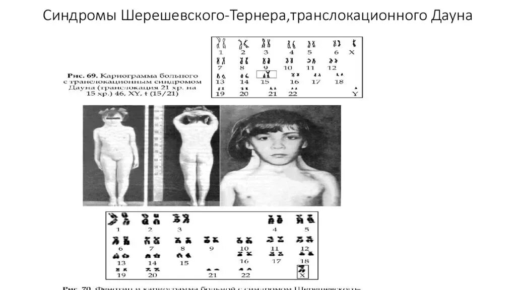 Тип мутации шерешевского тернера. Синдром дауна клайнфельтера шерешевского. шерешевского тернера люди. синдром шерешевского тернера кариотип. синдром шерешевского тернера клайнфельтера патау дауна.