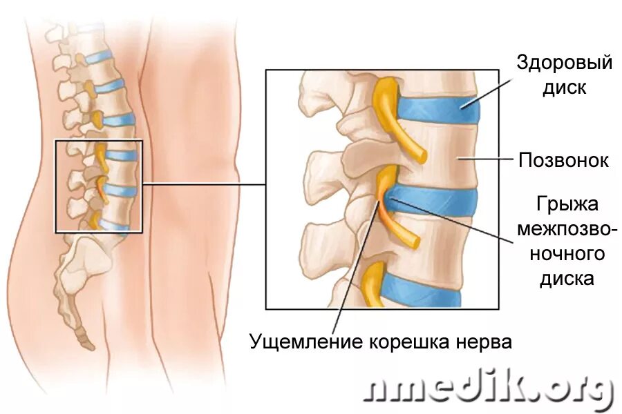 Межпозвонковая грыжа поясничного отдела лечение. Межпозвоночная грыжа грыжа поясничного отдела. Грыжа позвонка поясничного отдела. Грыжа позвоночника защемление нерва. Межпозвоночные диски пояснично крестцового отдела.