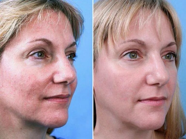 Лазерная шлифовка кожи цена skinlift ru. Фракционный фототермолиз со2 лазером. ДОТ- омоложение (лазерная со2 шлифовка):. Deka co2 (глубокий фракционный фототермолиз).