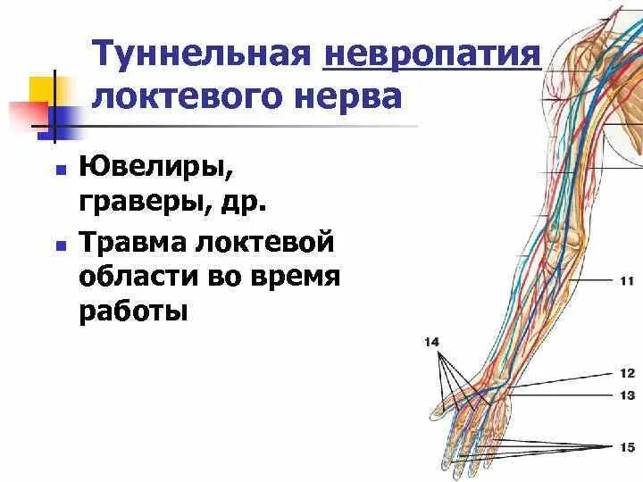 Невропатия локтевого нерва лечение. Туннельная невропатия срединного нерва. Туннельные нейропатии локтевой нерв. Невропатия локтевого нерва туннельный синдром. Туннельная нейропатия локтевого нерва симптомы.