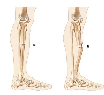 Fracture well