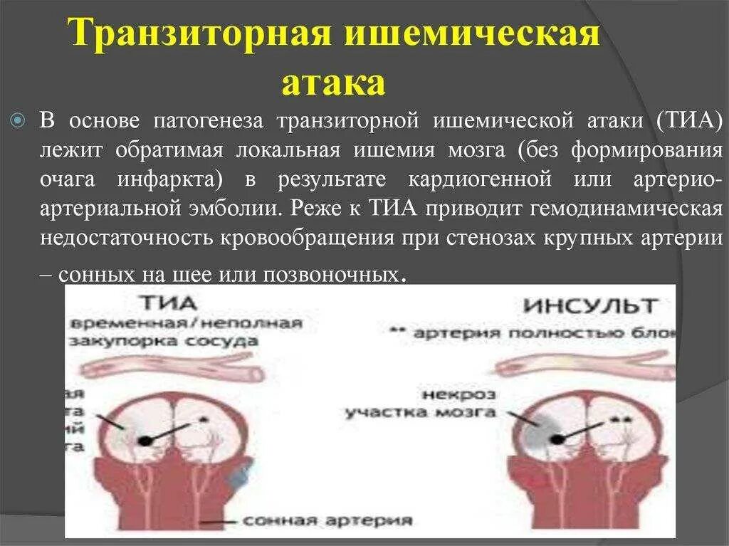 Последствия ишемической атаки мозга. Транзиторные ишемические атаки. Торзитарно ишемическая атака. Транзиторная ишемическая атака симптомы. Транзиторноишимическая атака.