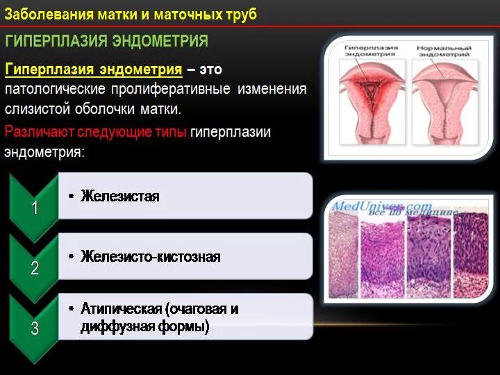 Стромальная гиперплазия эндометрия. Гормонозависимая гиперплазия эндометрия. Атипическая гиперплазия эндометрия диагноз. Онкобудни гиперплазия эндометрия.