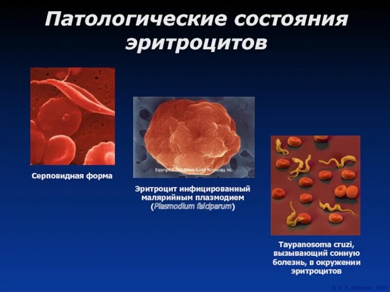 Виды изменения эритроцитов. Изменения эритроцитов. форма эритроцитов. морфологические изменения эритроцитов. патологические формы эритроцитов.