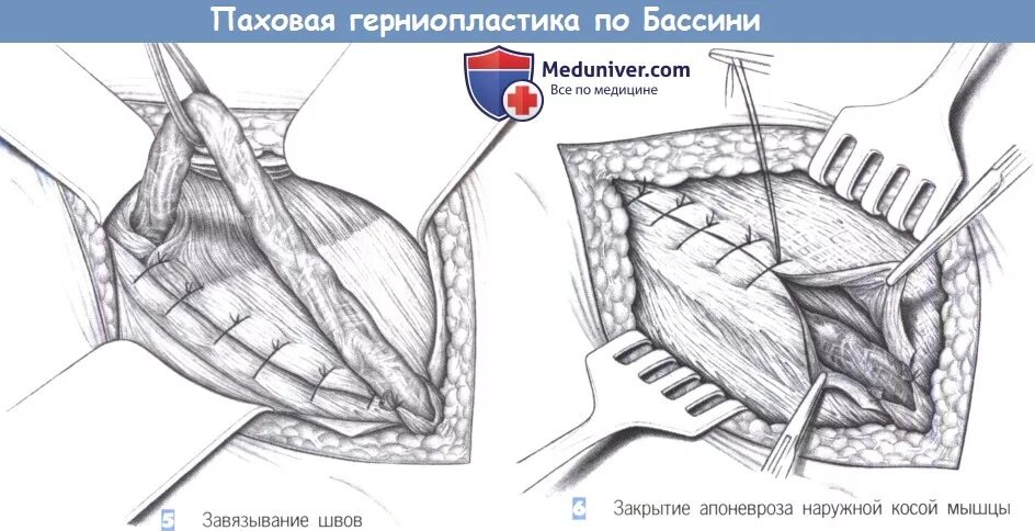 Пластика по Бассини при паховой грыже схема. Герниопластика Бассини. Пластика Бассини при паховой грыже. Грыжесечение, герниопластика по Бассини.. Лихтенштейн операция паховая