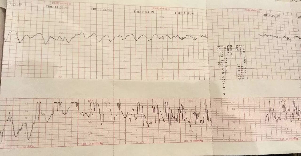 Ктг в родах