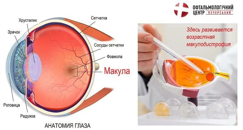 Лечение дегенерации макулы. Макула дистрофия сетчатки глаза. Макулярная дегенерация глаза. Макула сетчатки анатомия. Мембрана Бруха сетчатки глаза.