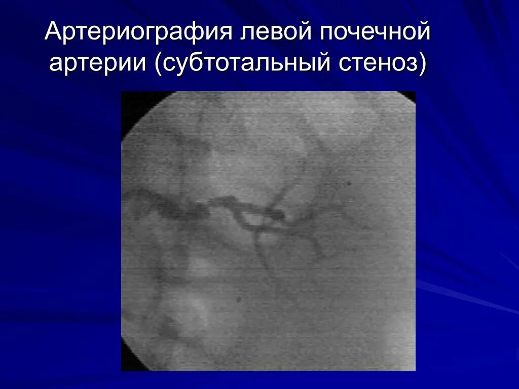 Артериография. Стеноз левой почечной артерии. Почечная артериография. Стеноз почечной артерии на УЗИ.