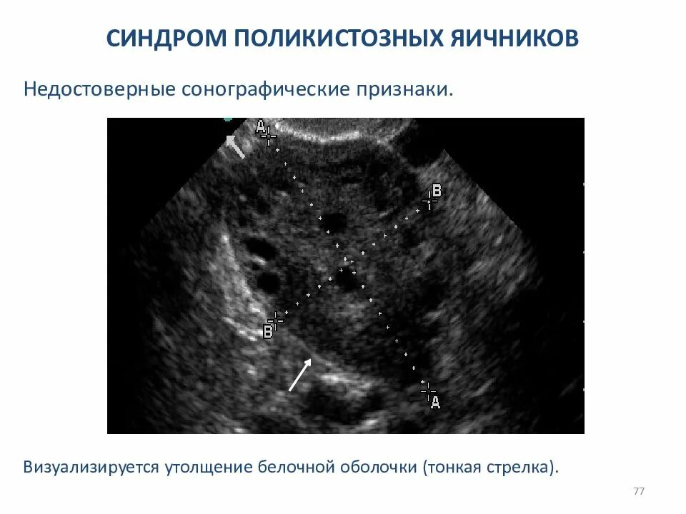 Кок при спкя. Поликистозных яичников. СПКЯ протокол. Синдром поликистозных яичников УЗИ. Синдром поликистозных яичников УЗИ признаки.