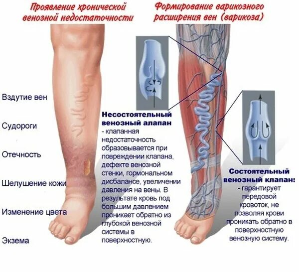 Хроническая венозная недостаточность нижних конечностей этиология. Хроническая венозная недостаточность факторы. Варикозное расширение вен (ВРВ) нижних конечностей. Клиника и диагностика варикозного расширения вен нижних конечностей.