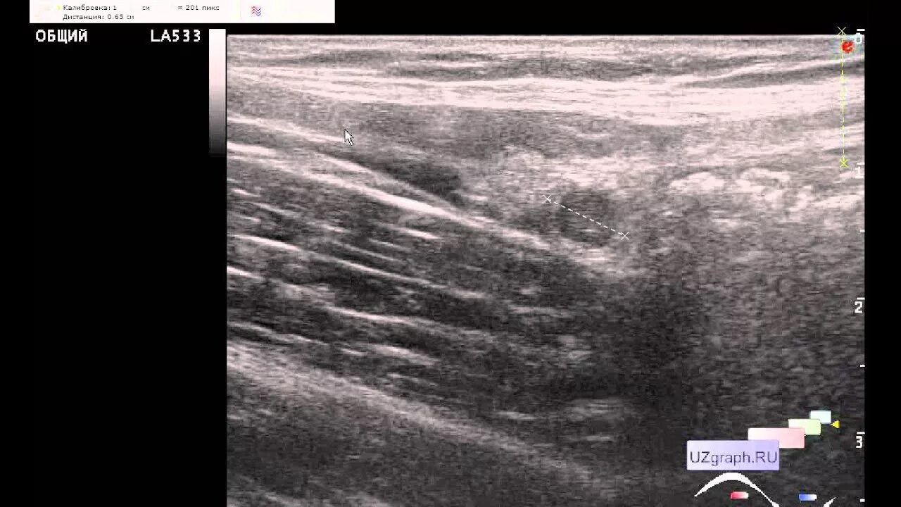 Разрыв икроножной мышцы на УЗИ фото. Гиперэхогенные кишечники на УЗИ. Фото снимок УЗИ желудок. Клинический случай ультразвуковая диагностика. Врач узи обучение ultrasonicthyroid ru