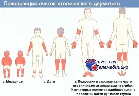 Проходит с возрастом