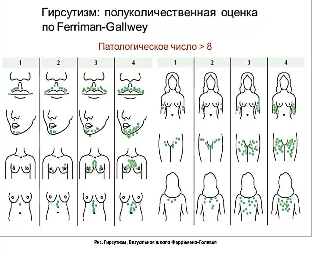 Виды сосков у девушки. Ферримана Голлвея. Шкала гирсутизма Ферримана Голлвея таблица. Шкала оценки гирсутизма. Модифицированная шкала Ферримана-Голлвея.