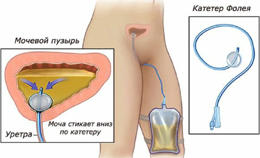 Моча после катетера