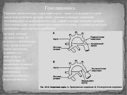 Гемодинамика коарктация
