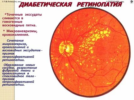 Диабетическая ретинопатия симптомы