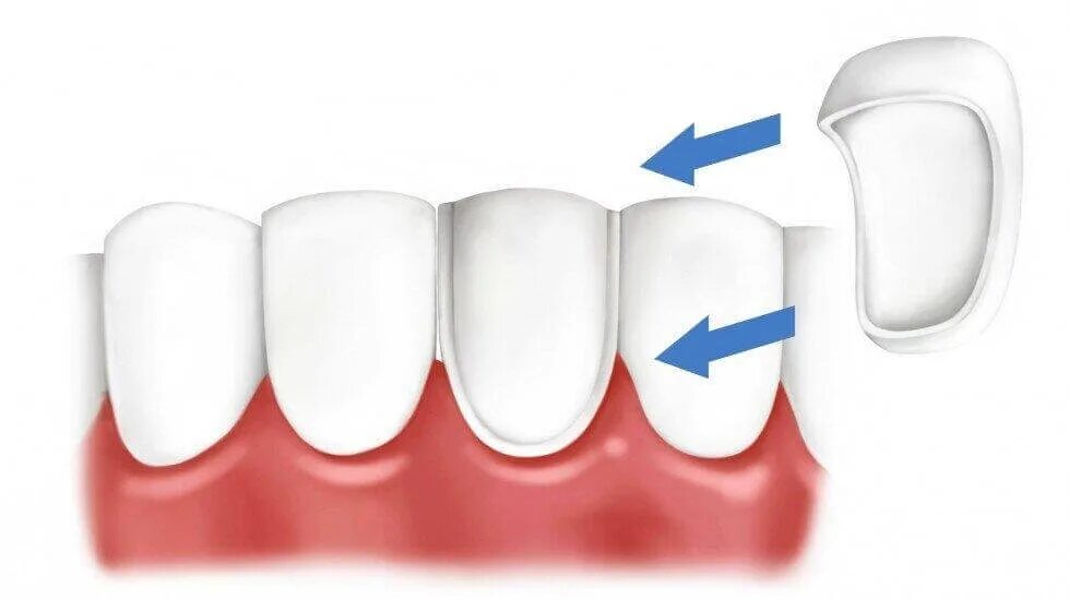 Винир прямой композитный. Прямые композитные виниры. виниры из композита и керамики.