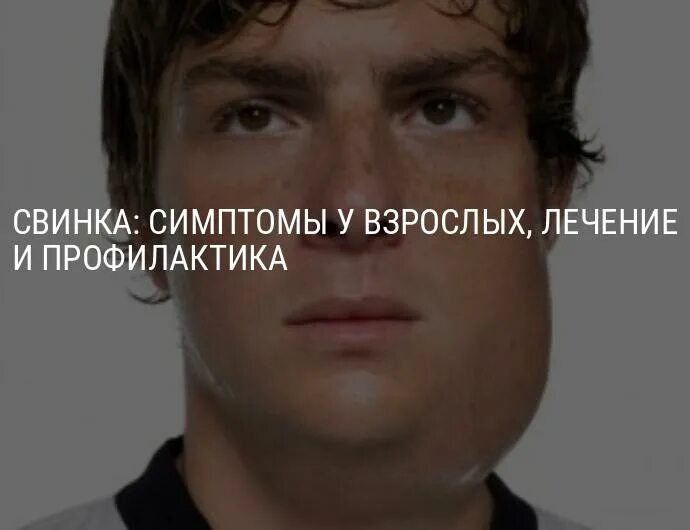 Свинка симптомы. Свинка симптомы у взрослых. Признаки свинки у взрослого.