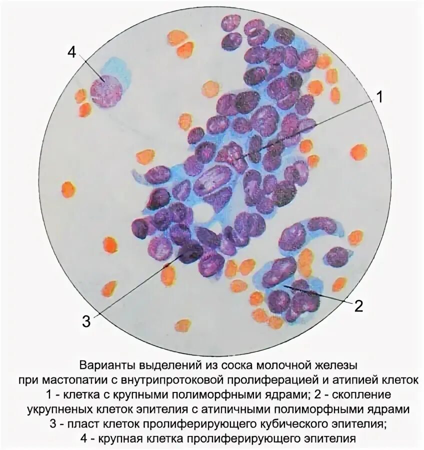 Пролиферация цилиндрического эпителия что это значит