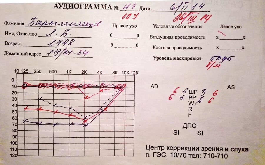 Расшифровка аудиометрии слуха норма. Аудиограмма слуха 3 степени. Аудиограмма 1 степени тугоухости. Норма аудиограммы для правого и левого уха. Аудиограмма ребенку