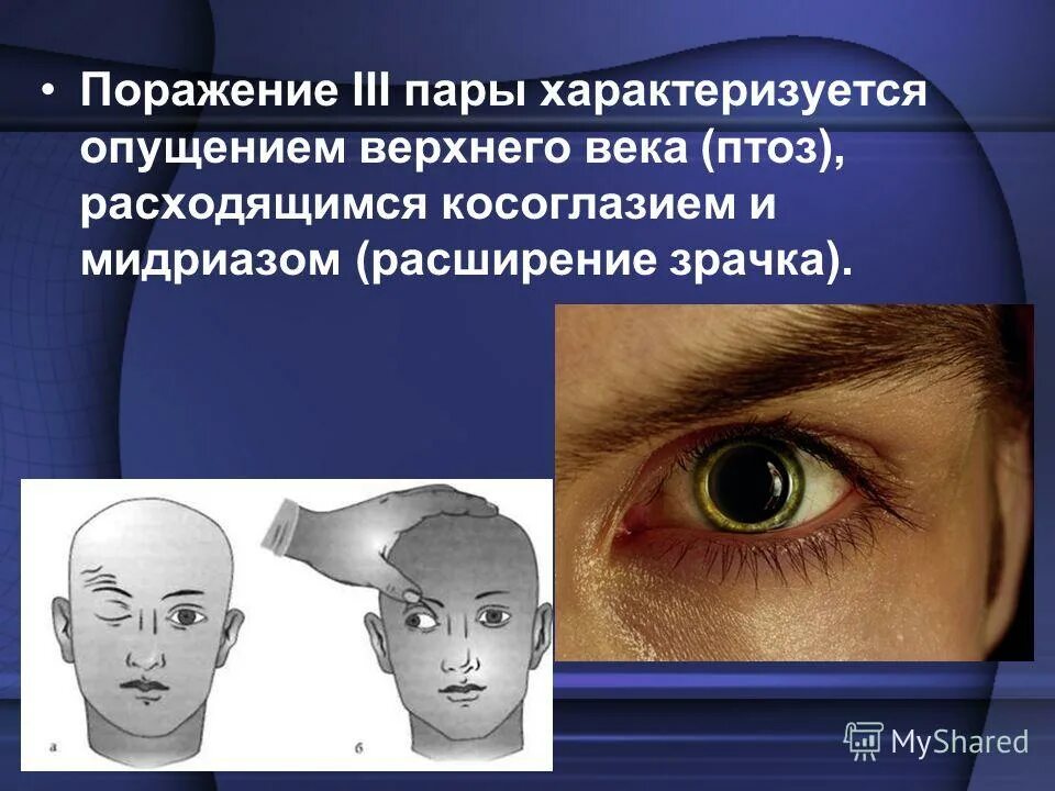 мужская любовь к мужчинам. парасимпатическая нервная система анатомия. Oculomotorius) - iii пара. пар iii. непарное ядро глазодвигательного нерва.